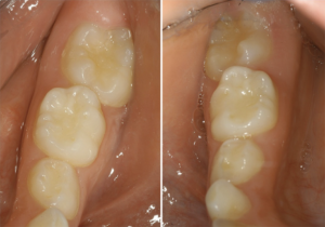 12 year molar symptoms