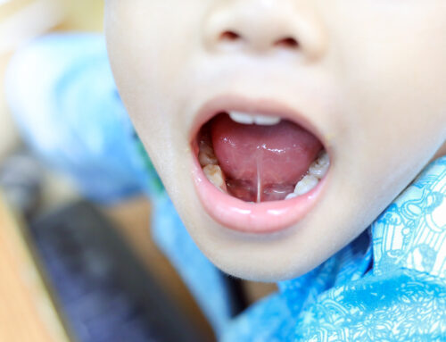 What is a tongue tie and why do we look for this during a dental examination?